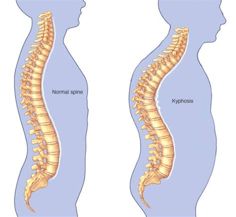 spine problems in elderly.